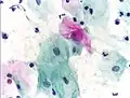 An obviously atypical cell can be seen.