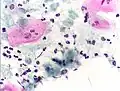 Infestation by Trichomonas vaginalis