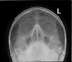 Paranasal sinuses radiograph (occipitomental)