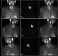 A nuclear medicine parathyroid scan demonstrates a parathyroid adenoma adjacent to the left inferior pole of the thyroid gland. The above study was performed with Technetium-Sestamibi (1st column) and iodine-123 (2nd column) simultaneous imaging and the subtraction technique (3rd column).