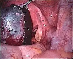 A silvery-brown cyst with a dark, viscous fluid leaking out