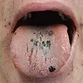 Petechia on the tongue in a person with decreased platelets due to ITP