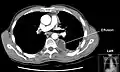CT scan of the chest showing a left-sided pleural effusion. The fluid usually settles at the lowest space due to gravity; in this case, at the back because the patient is supine.