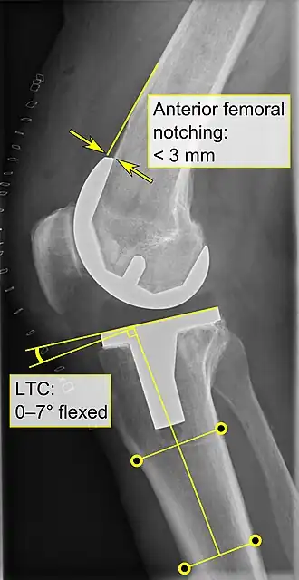 - Anterior femoral notching (the femoral component causing reduced thickness of the distal femur anteriorly), seems to cause an increased risk of fractures when exceeding about 3&nbsp;mm.[87] - LTC: lateral (or sagittal) tibial component angle, which is ideally positioned so that the tibia is 0–7° flexed compared to at a right angle with the tibial plate.[86]