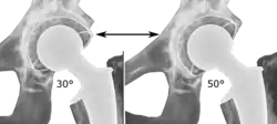 Acetabular inclination is normally between 30 and 50°.[110] A larger angle increases the risk of dislocation.[20]