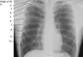 X-ray image of a human chest, with ribs labelled