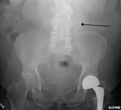 The faint outline of the calcified wall of an AAA as seen on a plain X-ray