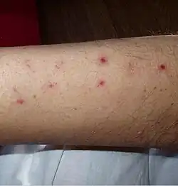 Numerous spots of bleeding into the skin of the leg in a person infected with T. b. rhodesiense[18]
