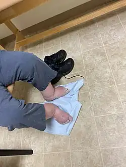 Severe edema in the legs and feet