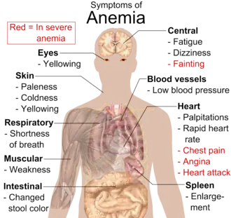 Chart listing symptoms of anemia and locating them to areas of the body. Eyes: yellowing. Skin: paleness, coldness, yellowing. Respiratory: shortness of breath. Muscular: weakness. Intestinal: changed stool color. Central: fatigue, dizziness; in severe cases fainting. Blood vessels: low blood pressure. Heart: palpitations, rapid heart rate; in severe cases chest pain, angina, heart attack. Spleen: enlargement.