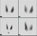 Thyroid scan with iodine-123 for evaluation of hyperthyroidism.