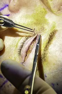 Close-up of a surgical blepharoplasty procedure showing an upper eyelid incision being closed with sutures using surgical instruments, with the eyelid crease visible.