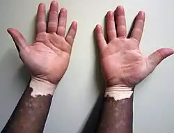 Nonsegmental vitiligo on dark skin