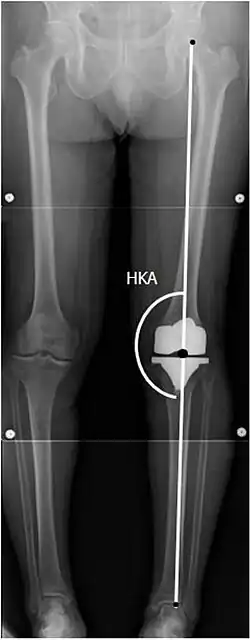 HKA: Hip-knee-ankle angle, which is ideally between 3° varum to 3° valgum from a right angle.[85]