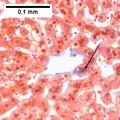 MASH (inflammation) and fibrosis stage 1